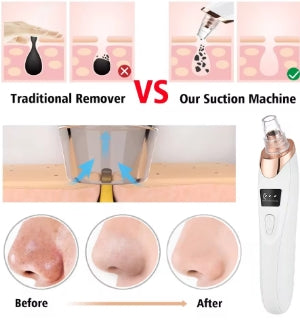 Electric Blackhead Remover