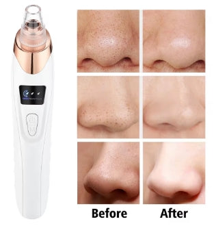 Electric Blackhead Remover